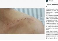 胡歌被曝拍偽裝者時砸斷女主鎖骨 因為要拍戲只能進行手術打了七顆鋼釘