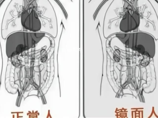 女子就醫發現五臟六腑全長反 什么是鏡面人