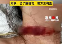 女子稱孕期遭家暴被丈夫拿刀割脖子 目前警方正在調(diào)查處理