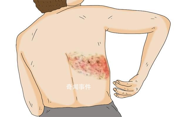 民間流傳纏腰龍纏一圈致命是謠言 帶狀皰疹的癥狀表現及治療方法