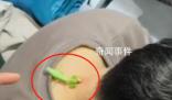 螳螂“大夫”為男子醫治脖后瘊子