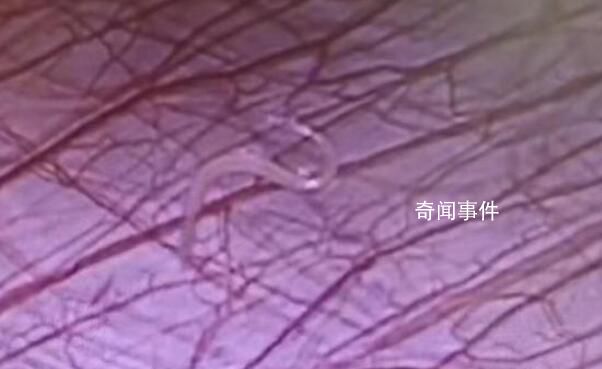 女孩外地求醫 切開闌尾有蟲子游出
