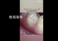 27歲女子長期橫向刷牙致牙齒缺損