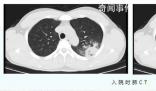 醫(yī)生:支原體肺炎成人也會(huì)中招 成人患者較以往增多