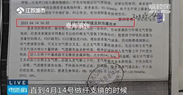 老人術后體內發現5顆牙和牙套 太離譜了