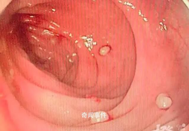 14歲男孩腸道里查出20多顆“珍珠”