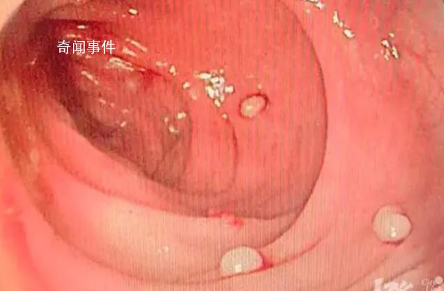 14歲男孩腸道里查出20多顆“珍珠”