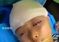 被打破頭骨女孩已出院 或有后遺癥