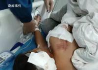 男童遭阿拉斯加犬咬傷 仍在ICU救治