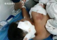 被狗咬傷男童已出ICU:耳朵缺一塊