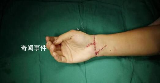 29歲小伙手腕被切斷醫生通宵縫合