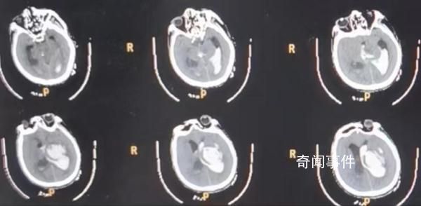 男子喂豬時暈倒 遭家豬啃食下半身