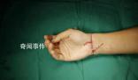 29歲小伙手腕被切斷醫生通宵縫合
