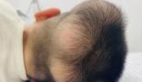 5歲男童患“超級罕見病” 國內此前僅報道過1例