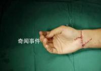 29歲小伙手腕被切斷醫生通宵縫合