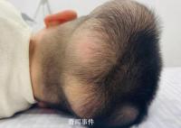 5歲男童患“超級罕見病” 國內此前僅報道過1例
