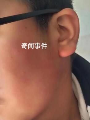疑因算錯題小學生被老師打耳光 致視力嚴重受損