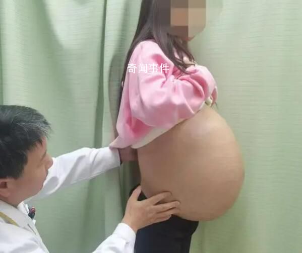 女子腹內(nèi)長出重46斤巨大脂肪肉瘤 腹部已高高隆起