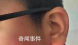 疑因算錯題小學(xué)生被老師打耳光 致視力嚴(yán)重受損