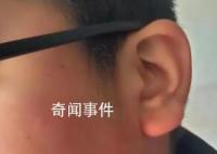 疑因算錯題小學生被老師打耳光 致視力嚴重受損