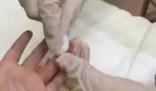 醫生給孩子采血手套殘留他人血跡 引發網友關注