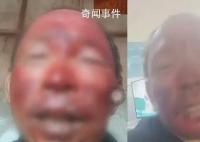 女婿去世女兒住院 男子燒傷不舍就醫