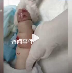 嬰兒遇輸液滲水起大片紅腫水泡 目前醫(yī)院正在積極處理