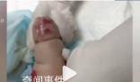 嬰兒遇輸液滲水起大片紅腫水泡 目前醫院正在積極處理