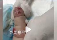 嬰兒遇輸液滲水起大片紅腫水泡 目前醫院正在積極處理