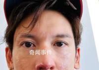 港星關智斌面部手部二級燒傷 面部和嘴唇變得紅腫