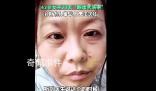 42歲斷崖式衰老女子確診卵巢早衰