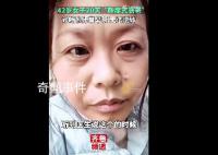42歲斷崖式衰老女子確診卵巢早衰