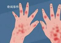 21歲男子發燒后被診斷為紅斑狼瘡 出現癥狀應及時就醫