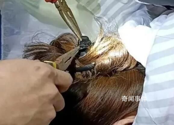 女子出車禍鯊魚夾插入后腦勺
