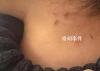 家長稱孩子遭老師虐待 身上都是摳痕