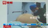 23歲女子腹脹如鼓取出42斤腫瘤