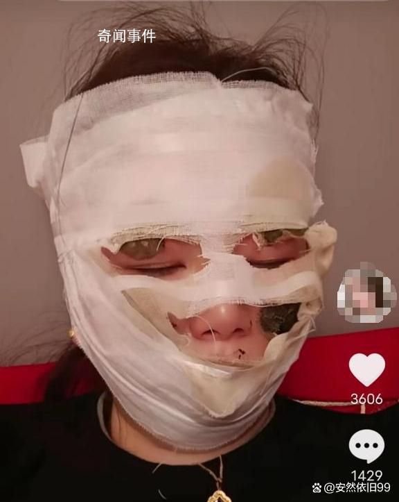 新娘結婚當天被噴霧彩帶燙傷