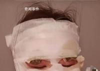 新娘結婚當天被噴霧彩帶燙傷