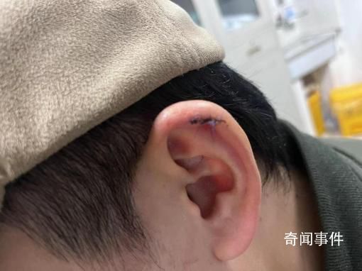 小伙理發時耳朵被剪縫六針 雙方決定等拆線后據傷情再協商